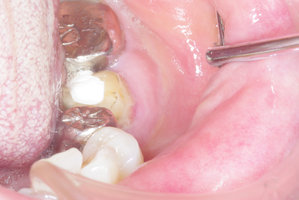 左下顎骨骨膜炎（口腔内）