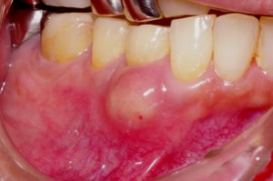 歯肉膿瘍