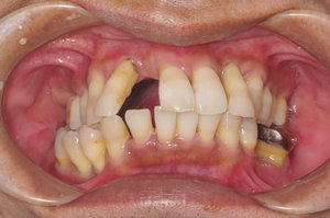 歯の傾斜