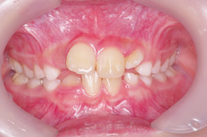歯の傾斜