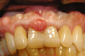 歯肉の良性腫瘤