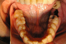 第二大臼歯の抜歯後