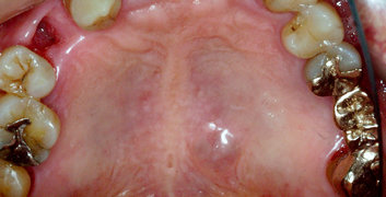 口蓋の良性腫瘍