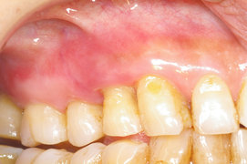 歯肉膿瘍の軽快
