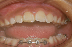 歯牙破折（修復後）