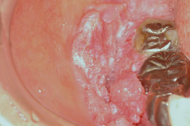 歯肉癌